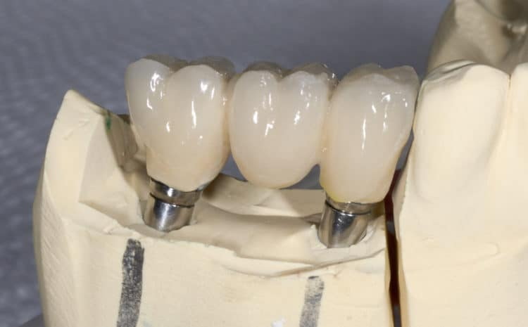What Are The Side Effects of A Dental Implant?