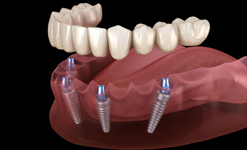 Should My Dental Implant Wiggle?