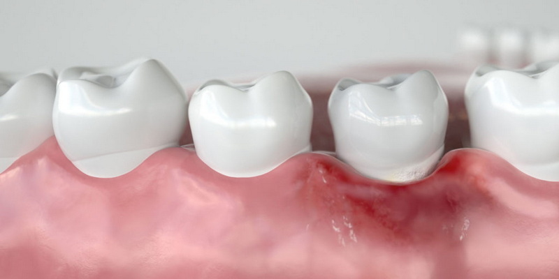 What Are The Signs of A Failing Dental Implant?