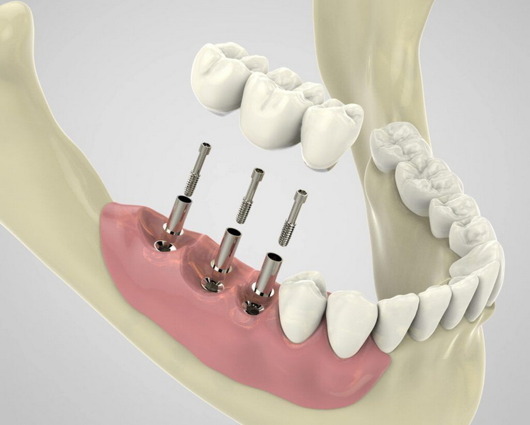 Can Dental Implant Be Replaced?