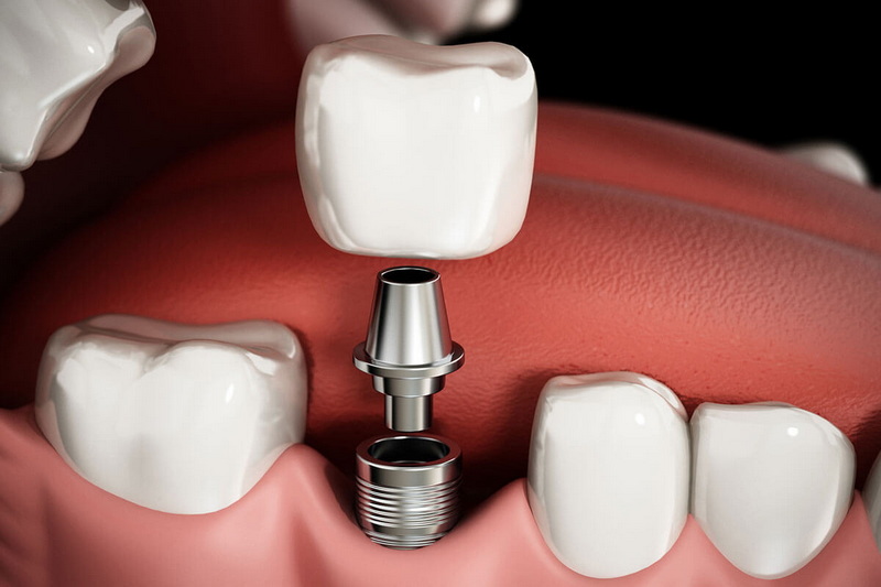 what is the best bone graft material for dental implant