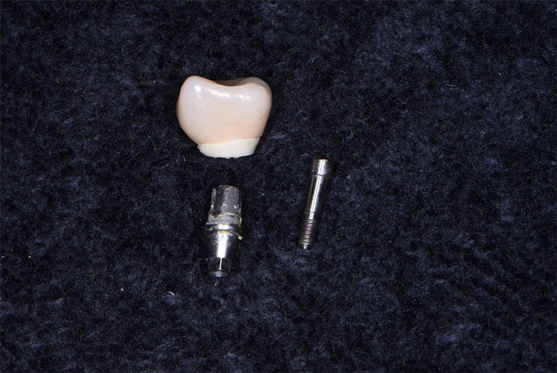 What Is A Dental Abutment Used for in Implants?