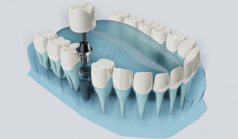 when can i vape after dental implant