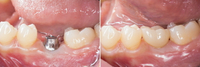 //iirorwxhloqjli5p.ldycdn.com/cloud/lrBpkKloljSRrllnolqrjq/dental-abutment-for-sale.jpg