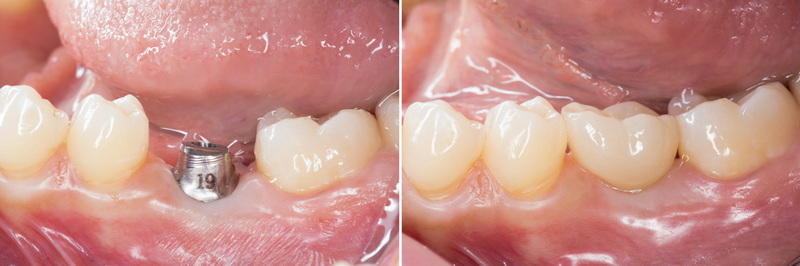 What To Consider When Buying A Dental Abutment For Sale?