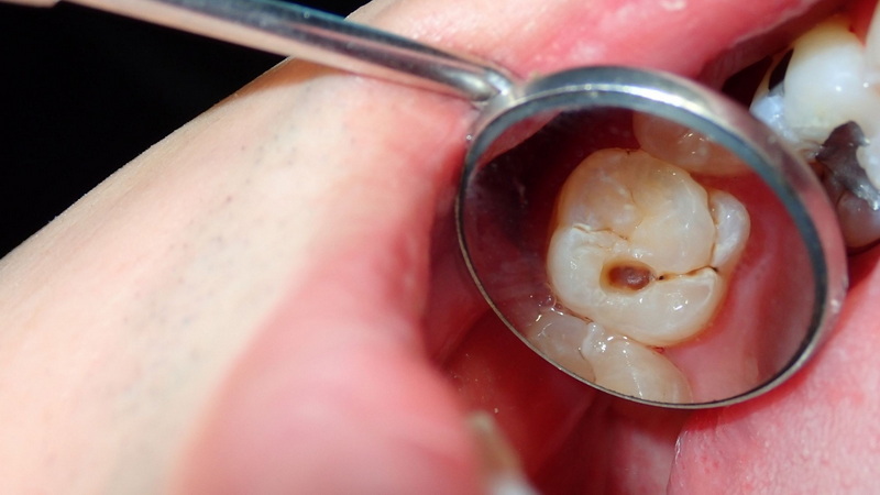 How To Tighten A Loose Dental Implant Abutment Screw?