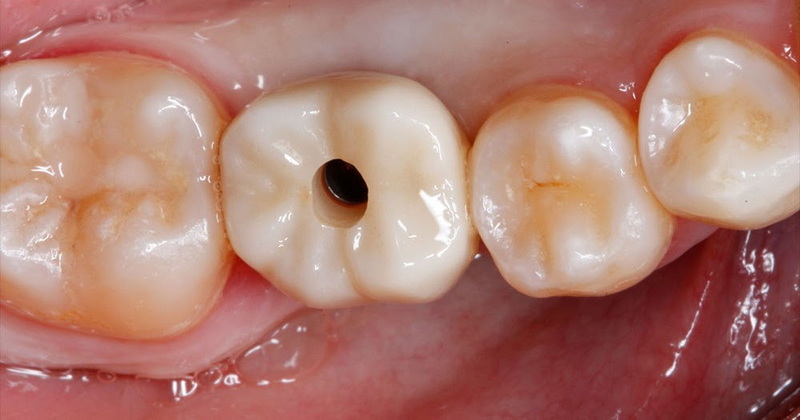 does the abutment screw into the implant