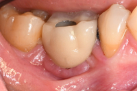 //iirorwxhloqjli5p.ldycdn.com/cloud/lrBpkKloljSRrlmlolmljp/dentium-healing-abutment.jpg
