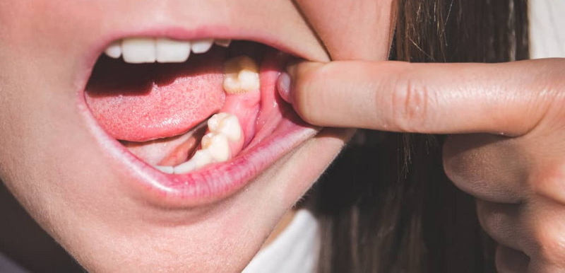 Can A Dental Implant Came Out?