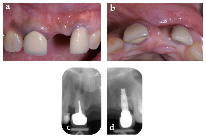 can a dental implant be used for a bridge