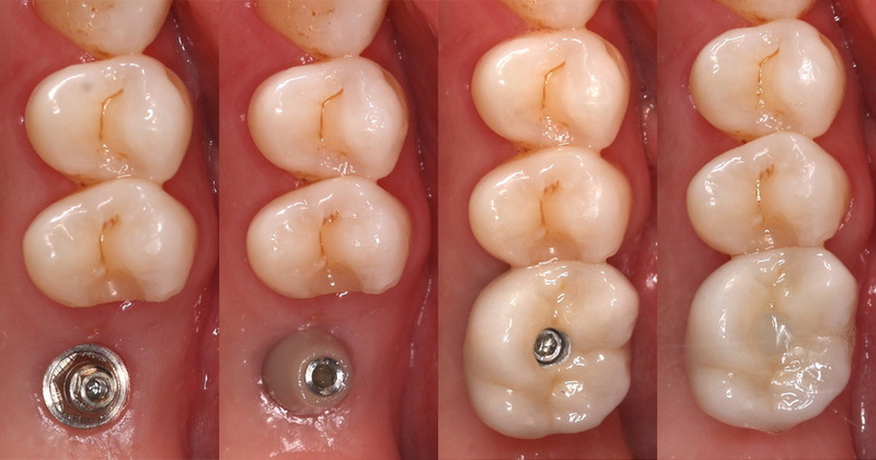cpt code for dental abutment