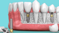 //iirorwxhloqjli5p.ldycdn.com/cloud/lrBpkKloljSRrlokkikrjo/can-you-eat-dairy-after-dental-implant.jpg