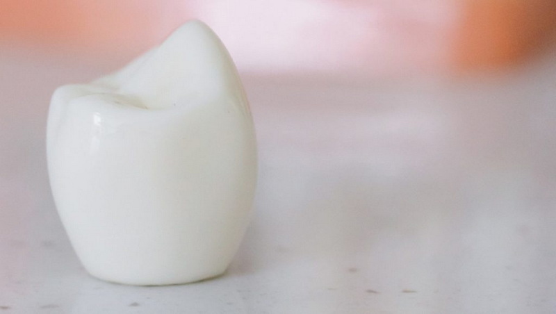 are dental implant more expensive than dental bridges