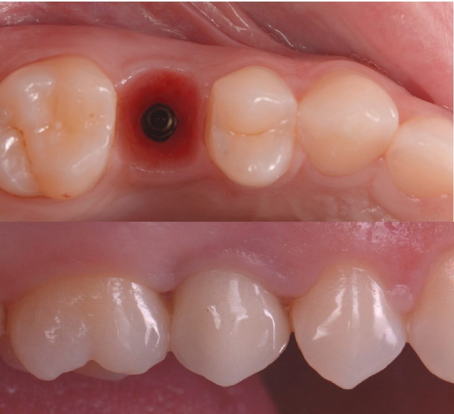 Are Dental Implant Grants Legitimate?