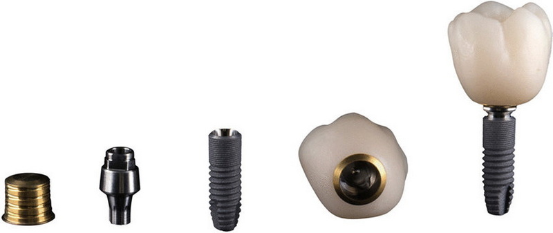 What Is The Best Way To Care for Your Gums During Abutment Recovery?