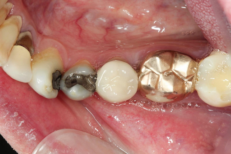 Can I Have A Dental Implant Taking Methotrexate?