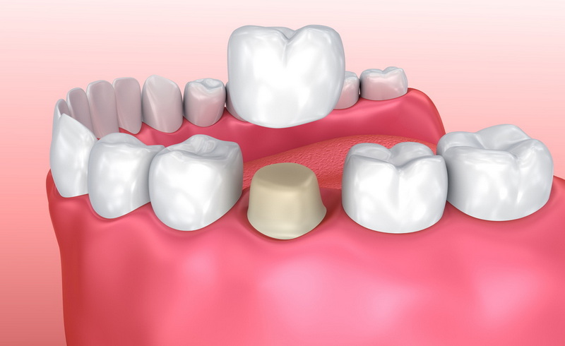 can i smoke with a flapless dental implant