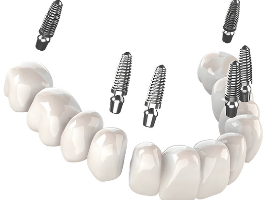 can you have a dental implant with bone loss