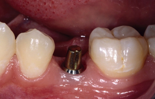 What Are The Signs Of A Failed Dental Abutment Screw?
