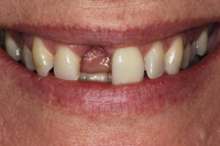 //iirorwxhloqjli5p.ldycdn.com/cloud/lrBpkKloljSRrlrljlorjo/ada-code-for-healing-abutment.jpg