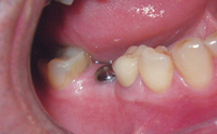 //iirorwxhloqjli5p.ldycdn.com/cloud/lrBpkKloljSRrlrlklkjjo/ankylos-healing-abutment.jpg