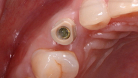 //iirorwxhloqjli5p.ldycdn.com/cloud/lrBpkKloljSRrlrlllopjq/bellatek-encode-healing-abutment.jpg