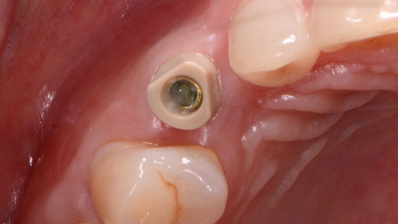 bellatek encode healing abutment