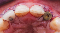 //iirorwxhloqjli5p.ldycdn.com/cloud/lrBpkKloljSRrlrlokmljq/nobel-healing-abutment-sizes.jpg