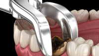 //iirorwxhloqjli5p.ldycdn.com/cloud/lrBpkKloljSRrlrlpoknjq/can-you-get-an-abscess-after-a-dental-implant.jpg