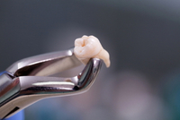//iirorwxhloqjli5p.ldycdn.com/cloud/lrBpkKloljSRrlrlrqmojq/loose-implant-abutment-screw.jpg