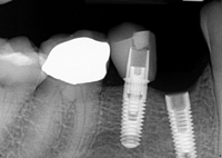//iirorwxhloqjli5p.ldycdn.com/cloud/lrBpkKloljSRrlrnirjpjo/can-you-have-a-large-back-dental-implant.jpg
