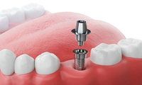 //iirorwxhloqjli5p.ldycdn.com/cloud/lrBpkKloljSRrlrnjrmrjo/can-you-make-a-dental-implant-on-your-own.jpg